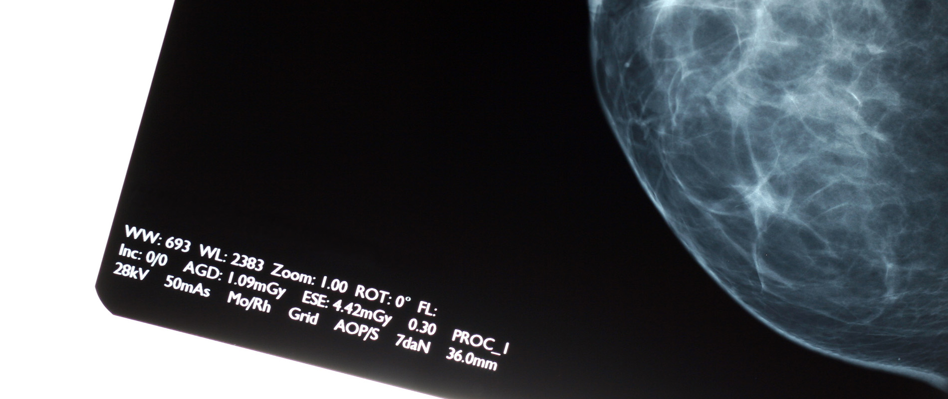 RTI x-ray Modality Mammography